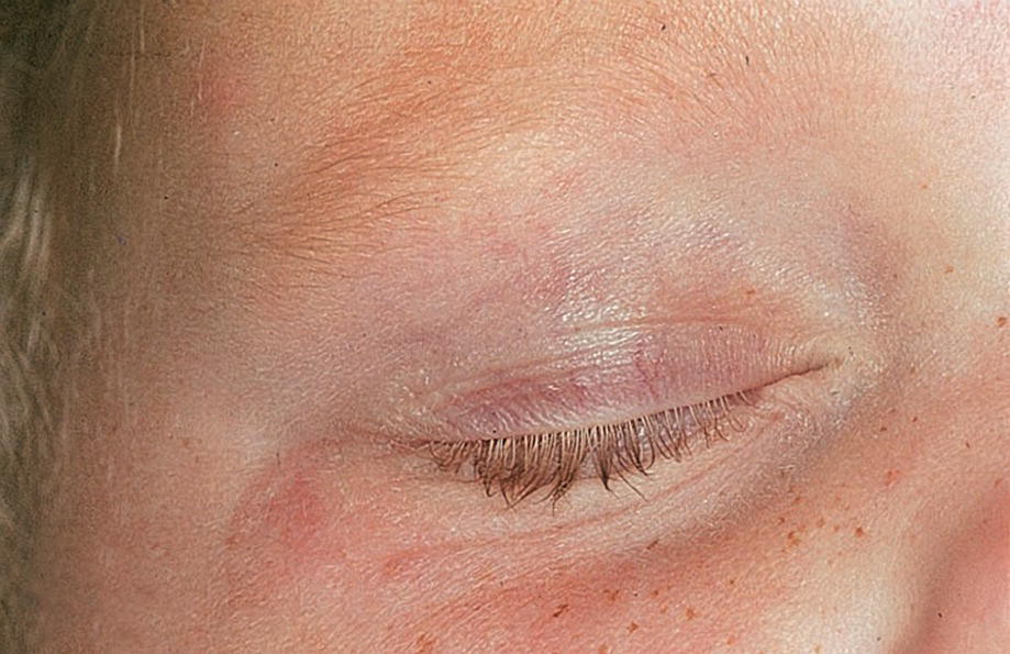 Photo displaying sparse eyebrows in a 12-year-old boy with ectodermal dysplasia.