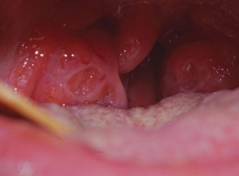 Photo displaying inflamed tonsils in 13‐year‐old girl.