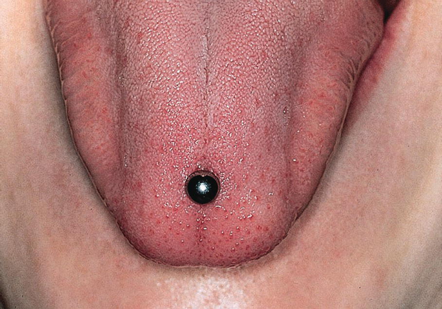 Photo displaying metallic object inserted in the tip of the tongue increasing the risk of damage to the soft oral as well as the hard dental tissues.