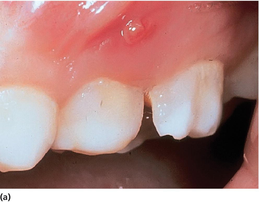 Photo of fistulae and abscesses due to caries in the primary dentition displaying a small sinus on the buccal mucosa.