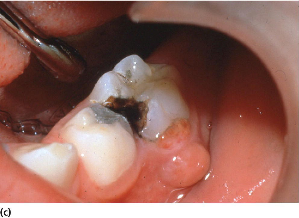 Photo of fistulae and abscesses due to caries in the primary dentition displaying large swellings with tooth cavity.