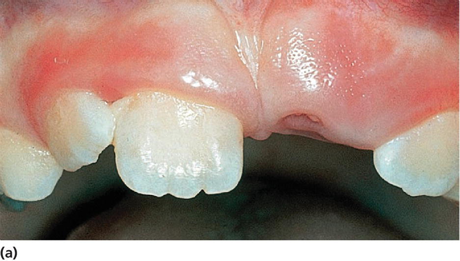 Photo displaying asymmetric eruption of incisors, with eruption of 21.