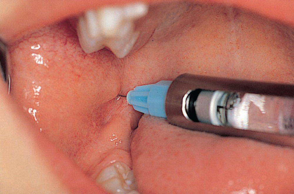 Photo of a child’s mouth with syringe injected laterally to the ptergomandibular fold.
