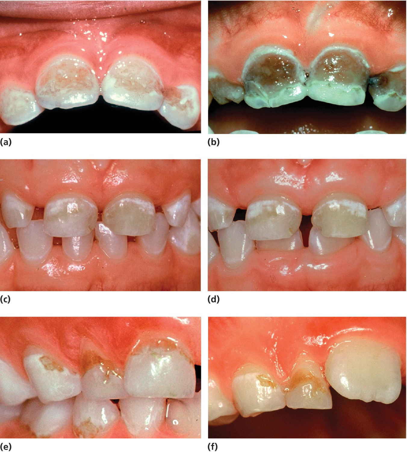 Photos of the teeth of an 11-month-old girl (a,b), 4-year-old- boy (c,d), and 6-year-old boy (e,f), with each displaying caries progression.