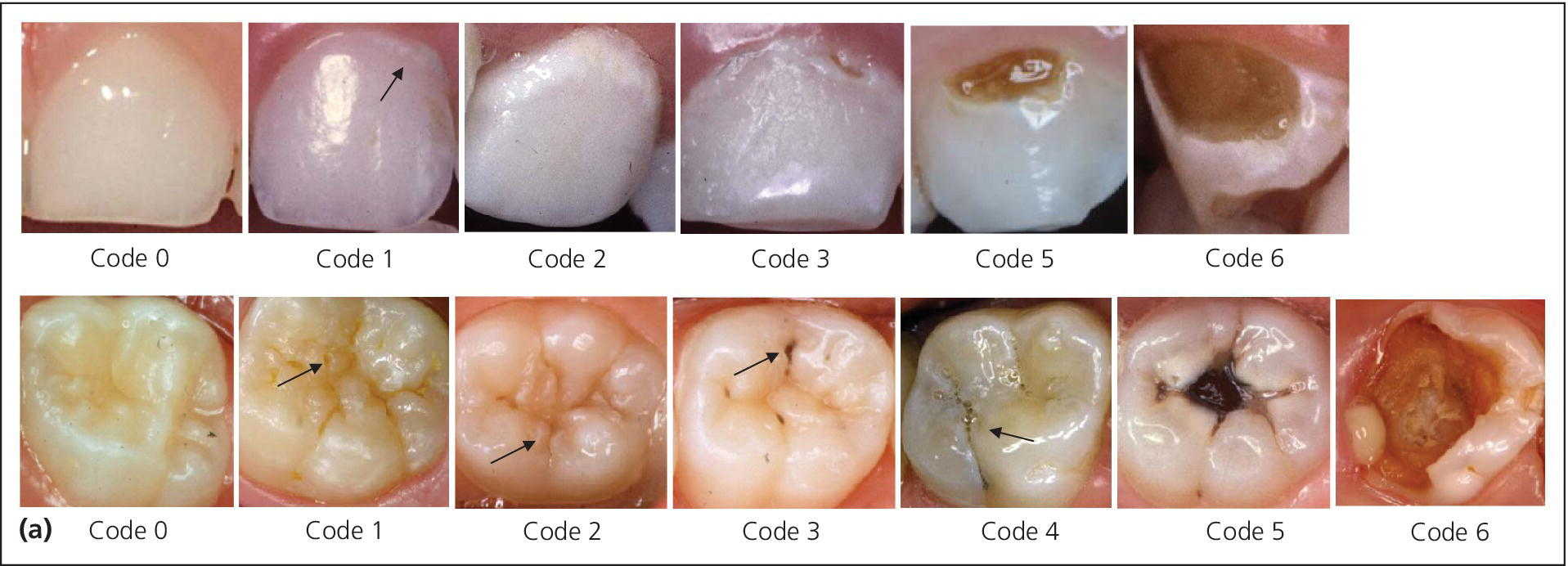 Classification Of Carious Lesions