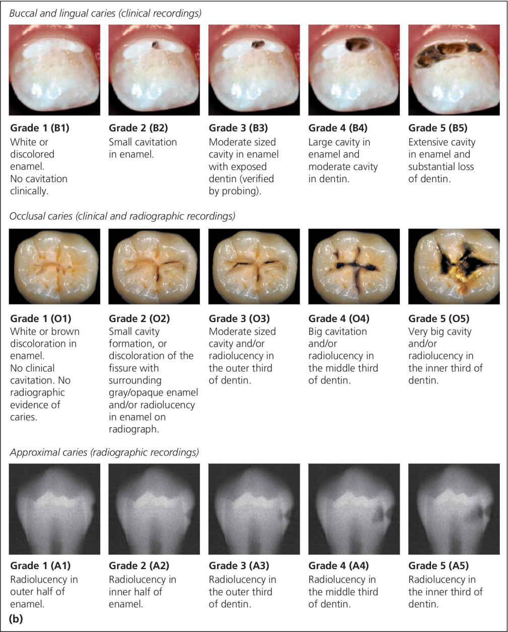 Two sets of photos and a set of radiographs of the teeth, depicting criteria using a five-graded scale for severity grading of caries on free smooth, occlusal, and approximal tooth surfaces.