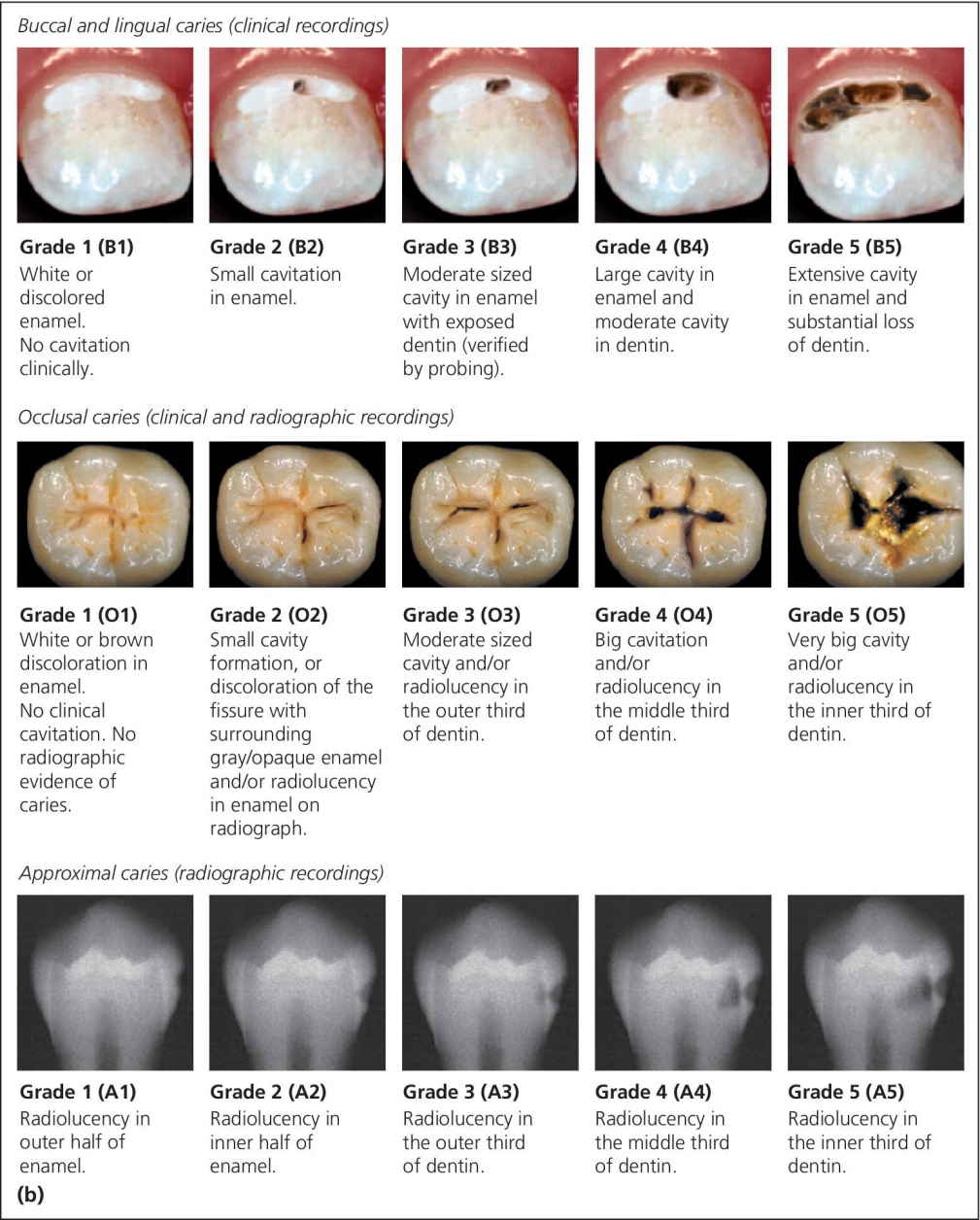 12 Diagnosis And Management Of Dental Caries Pocket Dentistry