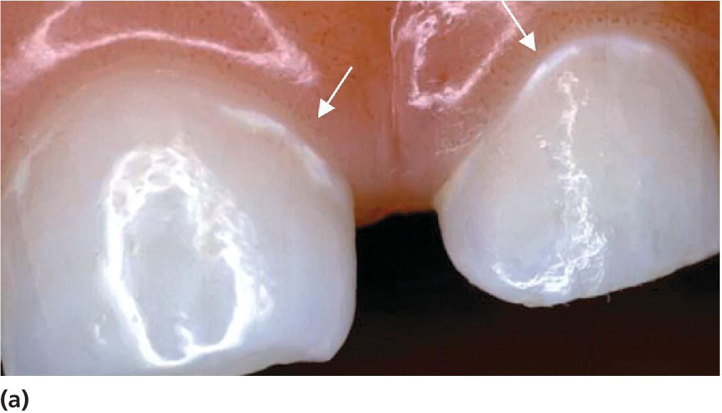 Photo displaying active noncavitated lesions close to the gingival line on the buccal surfaces of primary upper incisors in a 2-year-old.