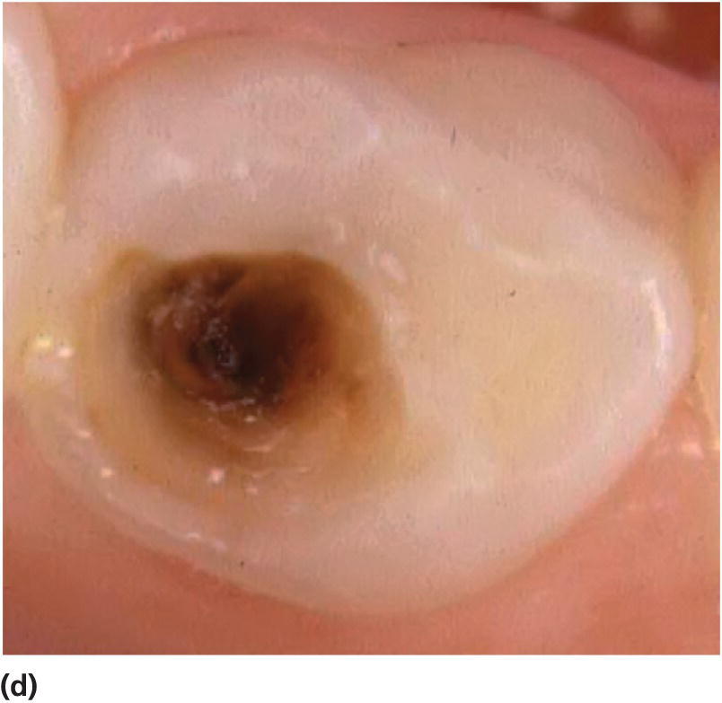 Photo displaying inactive (arrested) cavitated lesion in a primary lower first molar in a 7-year-old.
