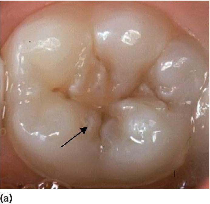 12 Diagnosis and Management of Dental Caries Pocket Dentistry