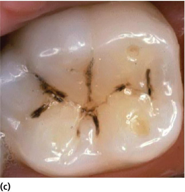 Photo displaying dark discolored fissures in a permanent first molar of a 19-year-old, with a low caries activity.