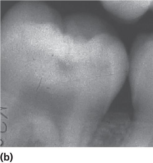 Bitewing radiograph of the permanent lower second molar of a 14-year-old child, displaying obvious radiolucency in the dentin.