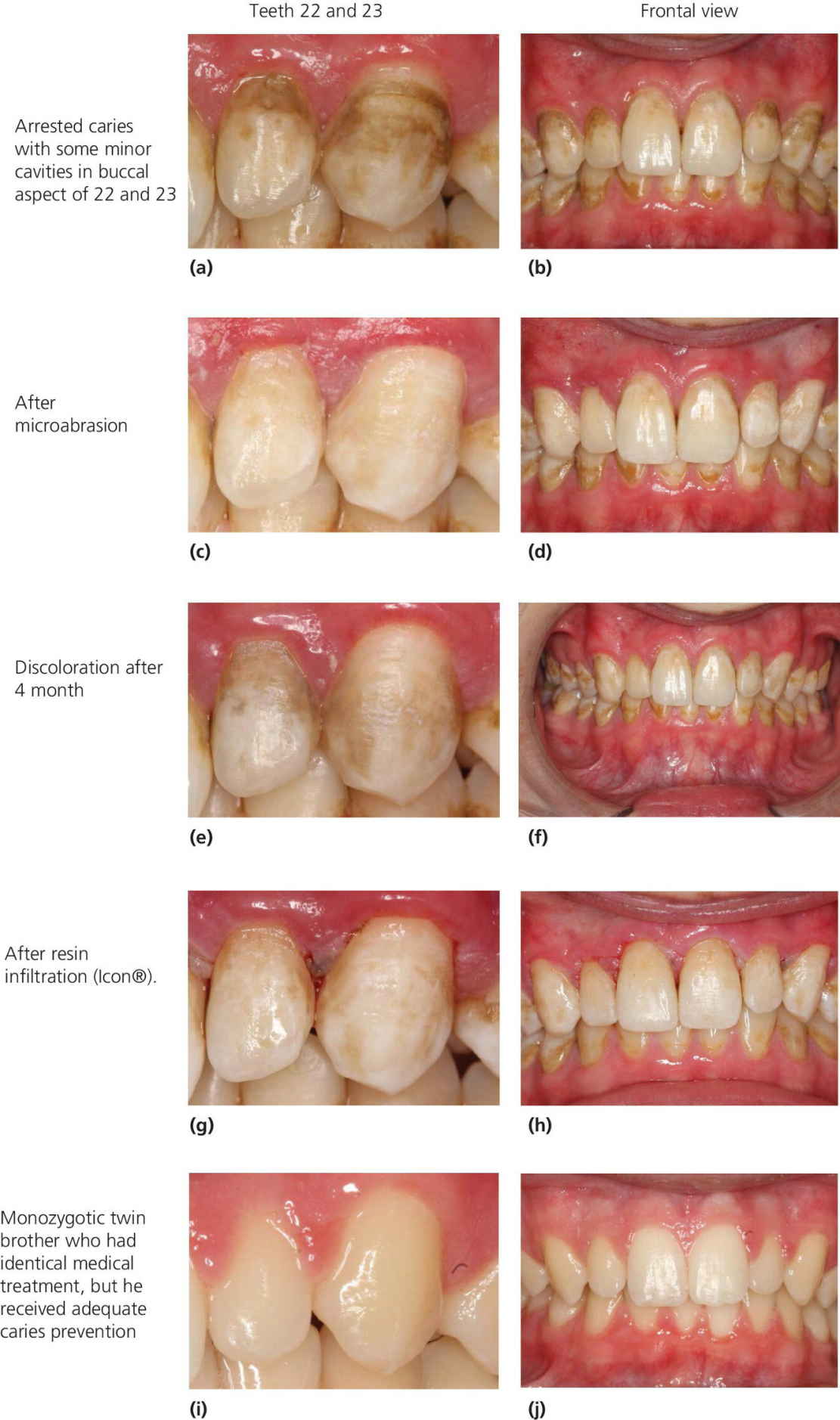 minor cavity