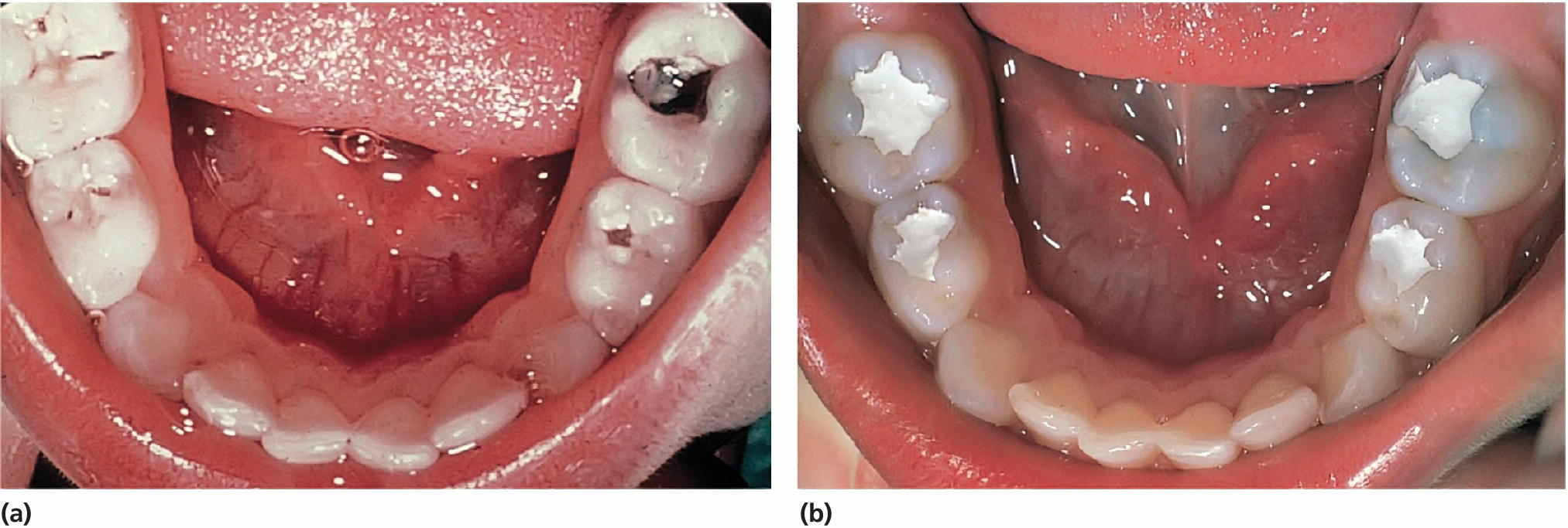 Management of deep dental caries