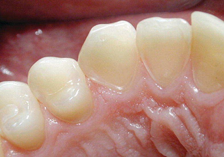 Photo displaying severe erosion on the palatal surface of the upper incisors with the enamel close to the gingival margin being intact.