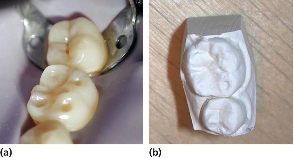2 Photos displaying cuppings on a permanent first lower molar (tooth 36) in a young teenager (left) and a study cast from the same case (right).