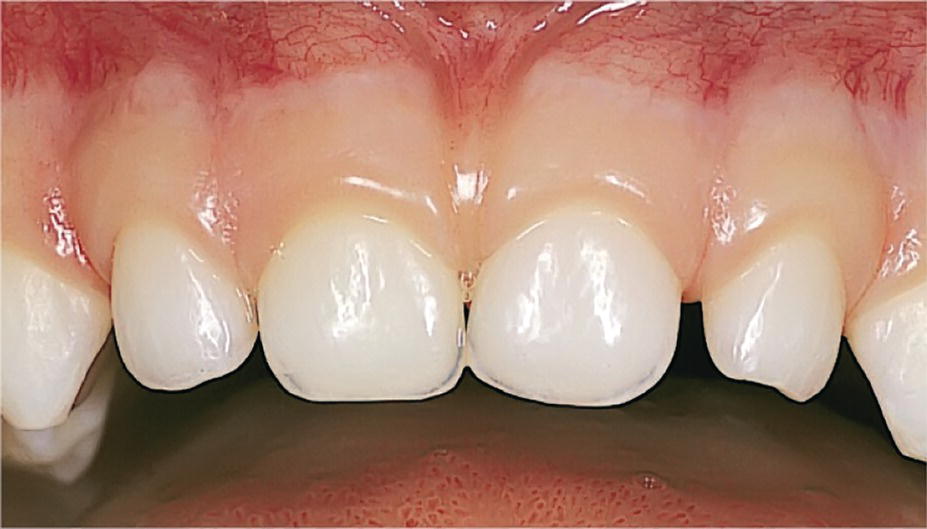 Photo of maxillary teeth with clinically healthy primary tooth gingiva.