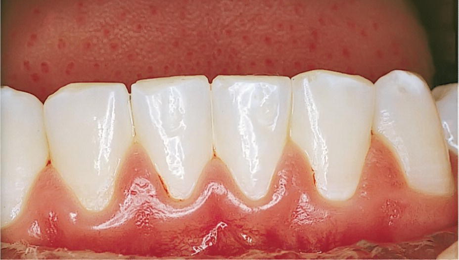 Photo of mandibular teeth with chronic gingivitis.