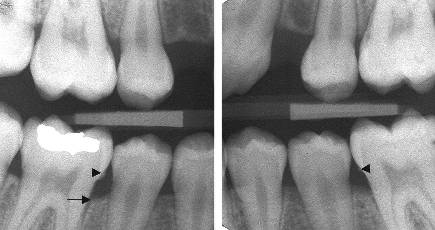 Radiographs of a 14‐year‐old boy displaying proximal subgingival calculus and minor bone loss at mandibular permanent first molars. Arrow indicates bone loss and arrowheads indicate subgingival calculus.