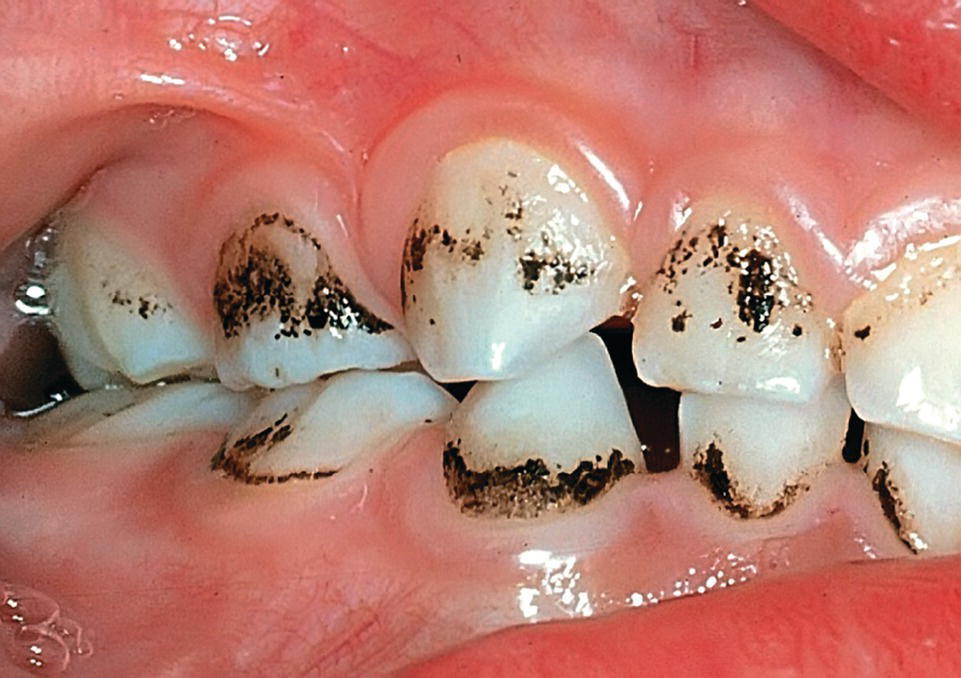 Photo of teeth displaying a thin, darkly pigmented line or stains located at the cervical part of tooth enamel.