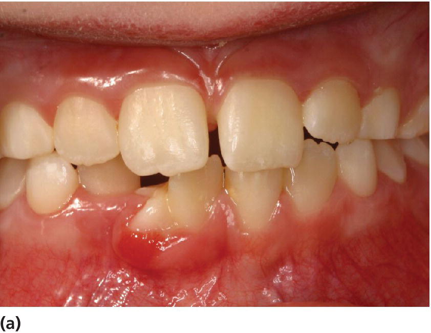 Photo of frontal view of tooth 41 displaying gingivitis in relation to dens geminatus in the incisal region of the lower jaw.