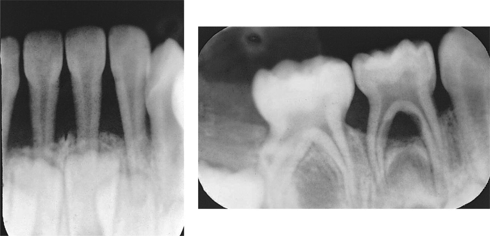 Dental radiographs of a 3-year-old boy with a generalized form of aggressive periodontitis. The primary teeth in all quadrants are involved.