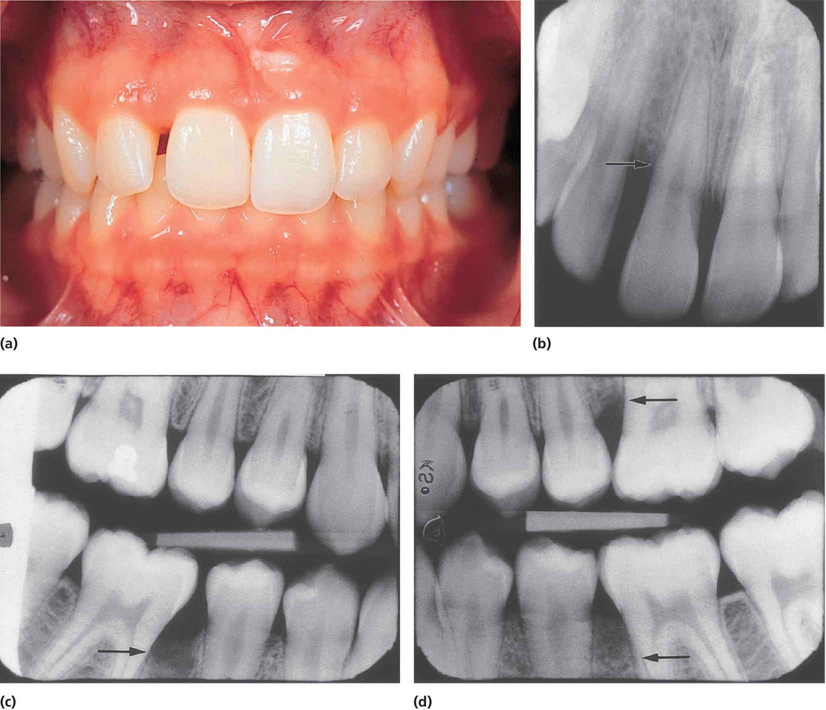 Photo of a patient’s bite displaying localized aggressive periodontitis (a). Radiograph of incisors (b) and two bitewing radiographs (c,d) present bone destruction as located by arrows.