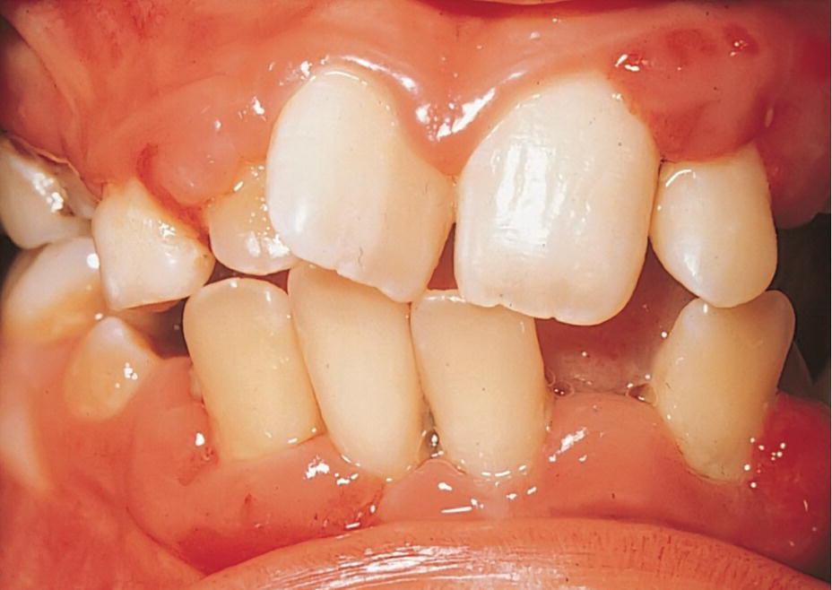 Photo of a bite of a young child with diabetes mellitus, displaying severe periondontal involvement.