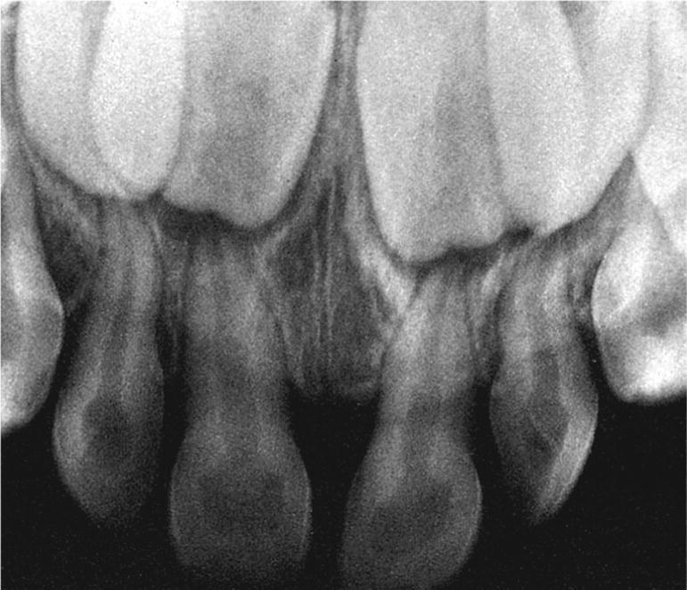 Radiograph displaying alveolar bone loss in a child with hypophosphatasia.