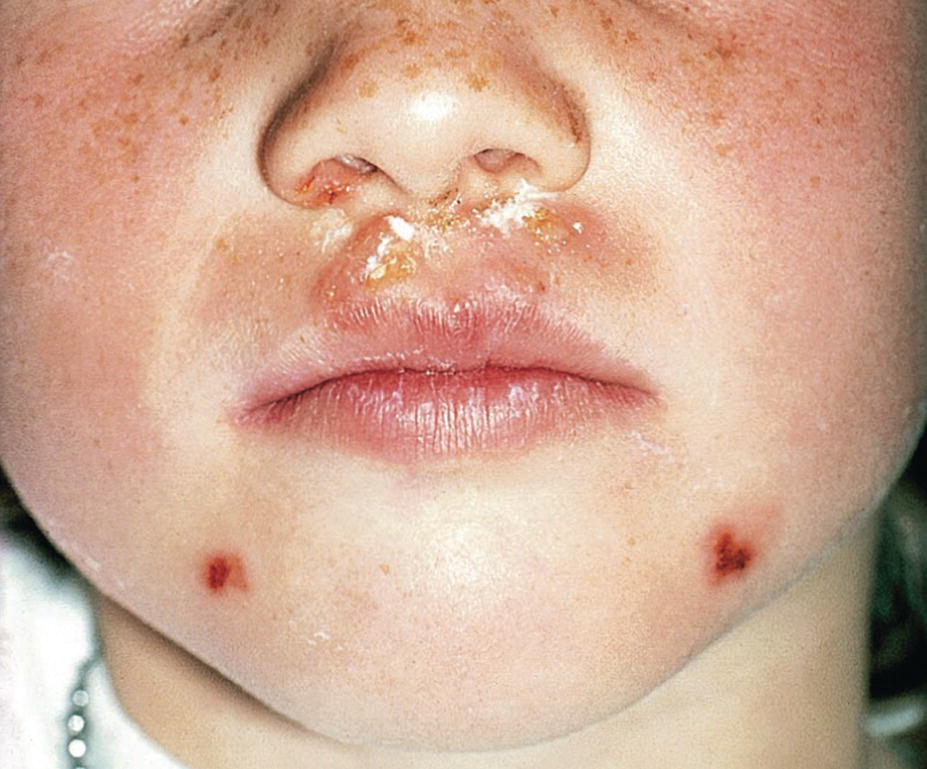 Photo displaying impetigo contagiosa on the upper lip and chin of a 7‐year‐old girl.