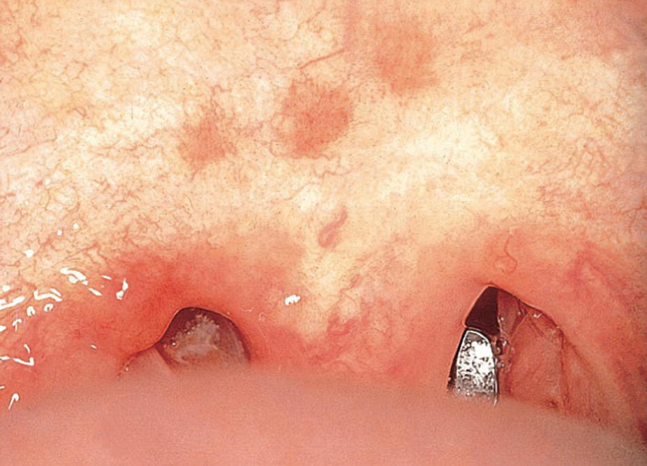 Photo displaying Forschheimer’s spots on the soft palate in a child with rubella.