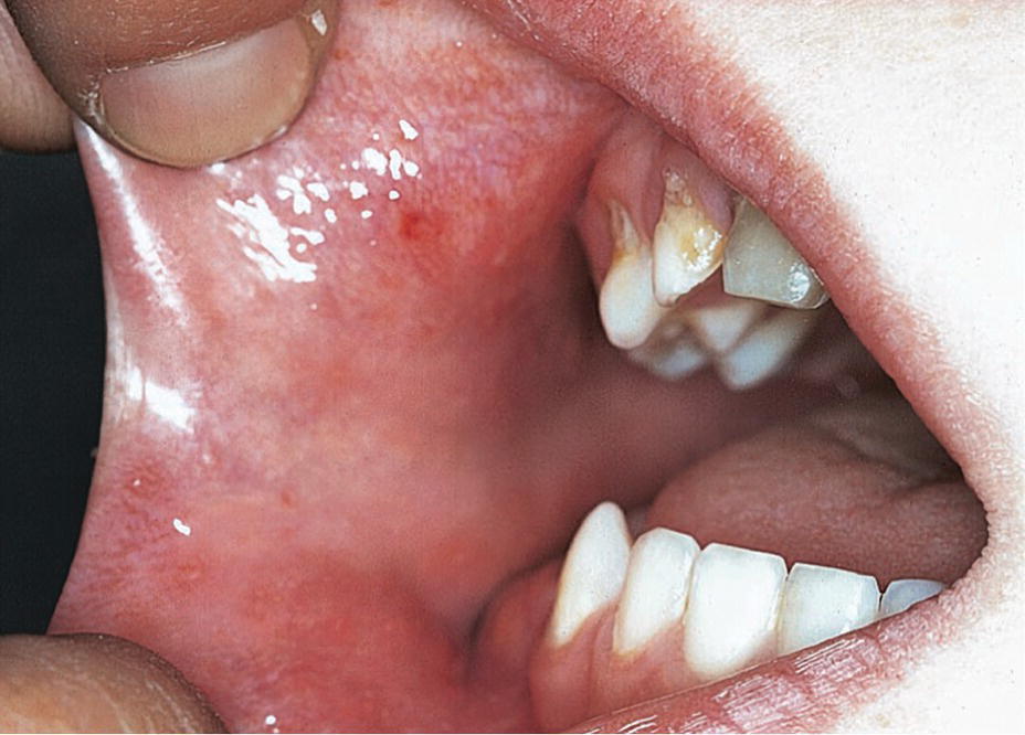 Photo displaying Koplik’s spots in the cheek mucosa in a child with measles.