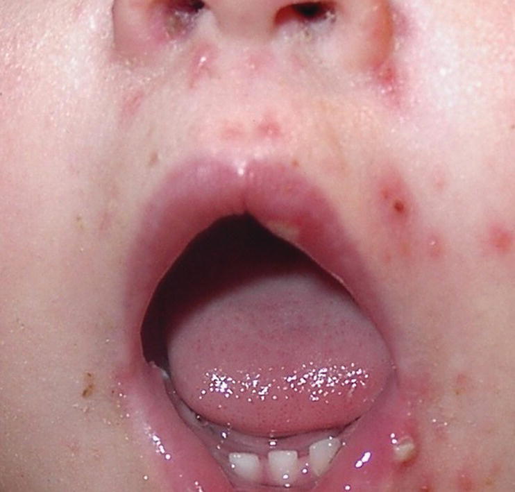 Photo displaying vesicular lesions on the skin in a child with varicella (chickenpox).