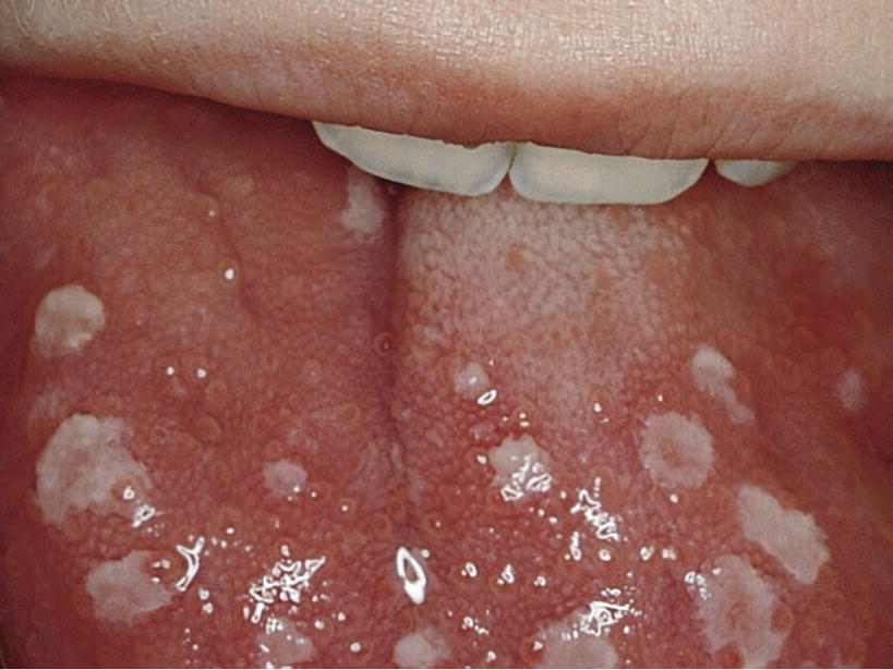 Photo displaying vesicles on the mucosa of the tongue in a child with varicella.