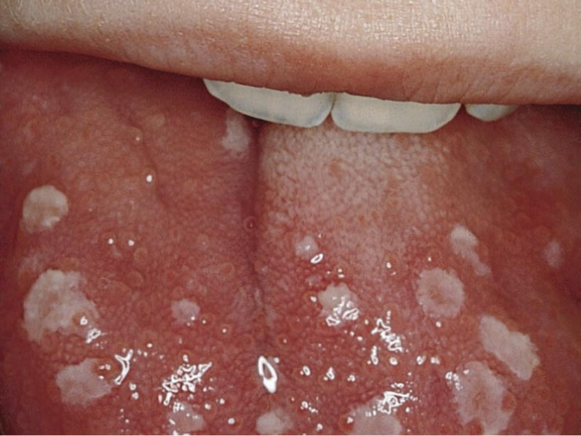 White Spots On The Back Of Your Tongue at Dennis Mosely blog