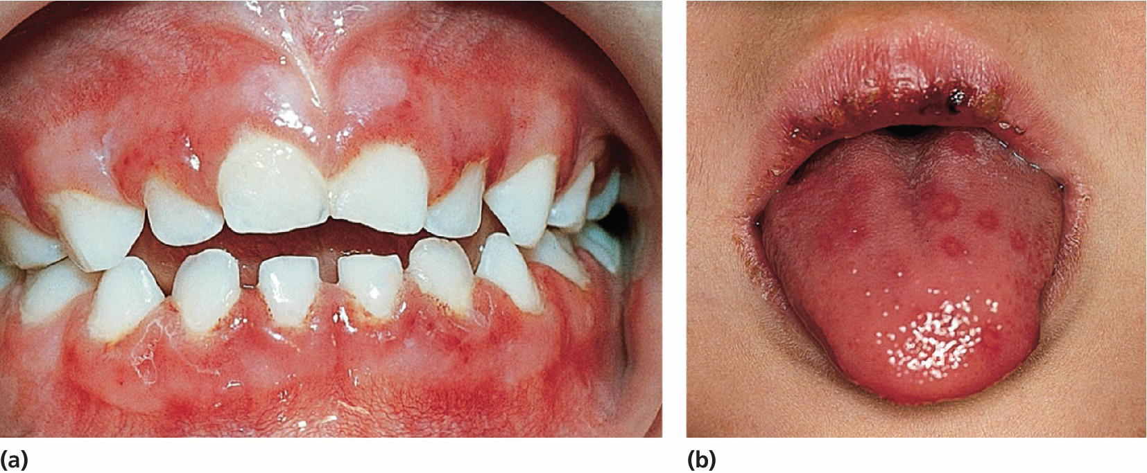 2 Photos displaying herpes simplex lesions spread over the alveolar mucosa (a) and tongue (b).