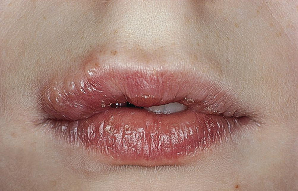 Photo displaying herpes labialis.