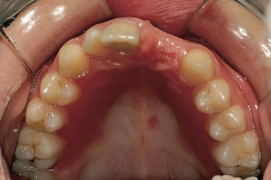 Photo displaying Candida albicans infection of the palatal mucosa in child with a partial denture.