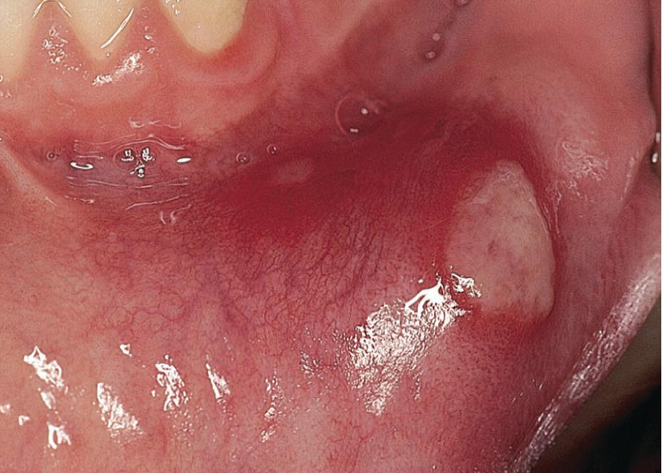 Photo displaying aphthous ulcer on the labial mucosa.