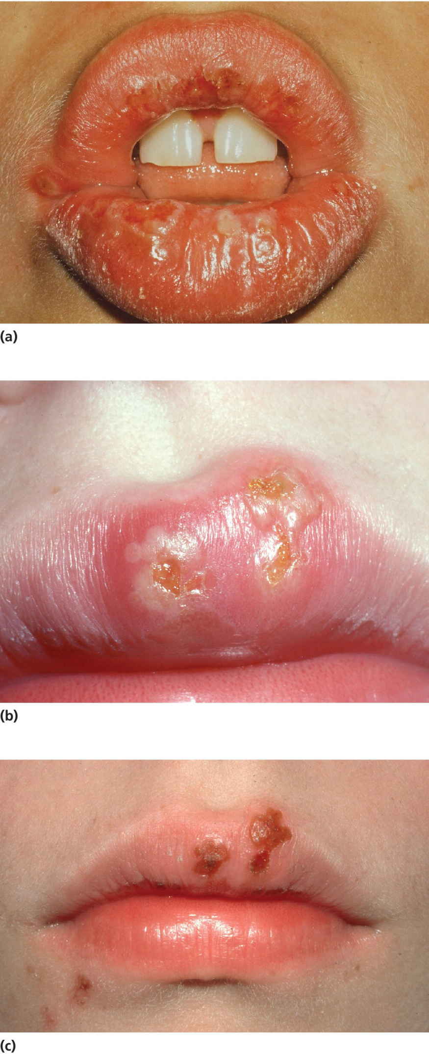 Photo of oral lesions with vesicles and bullae which rapidly burst (top), lesions after 2–3 days (middle), and crust formation/healing 2 days later (bottom).