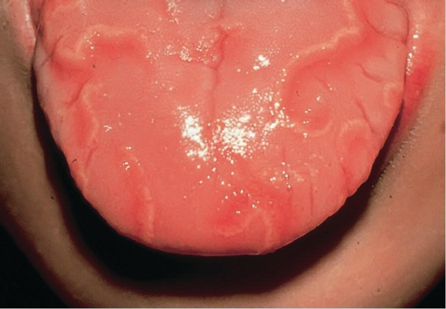 Photo of a geographic tongue.