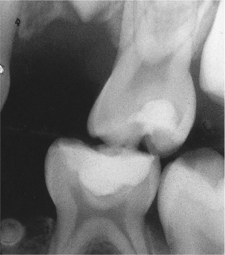 Radiograph of two primary second molars after stepwise excavation.