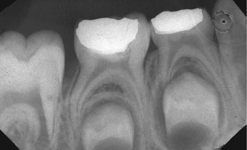 Radiograph of primary second molar after partial pulpotomy.