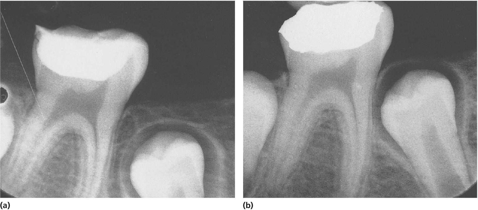 2 Radiographs of stepwise excavation of a permanent molar at the time of treatment (a) and 9 months later (b).