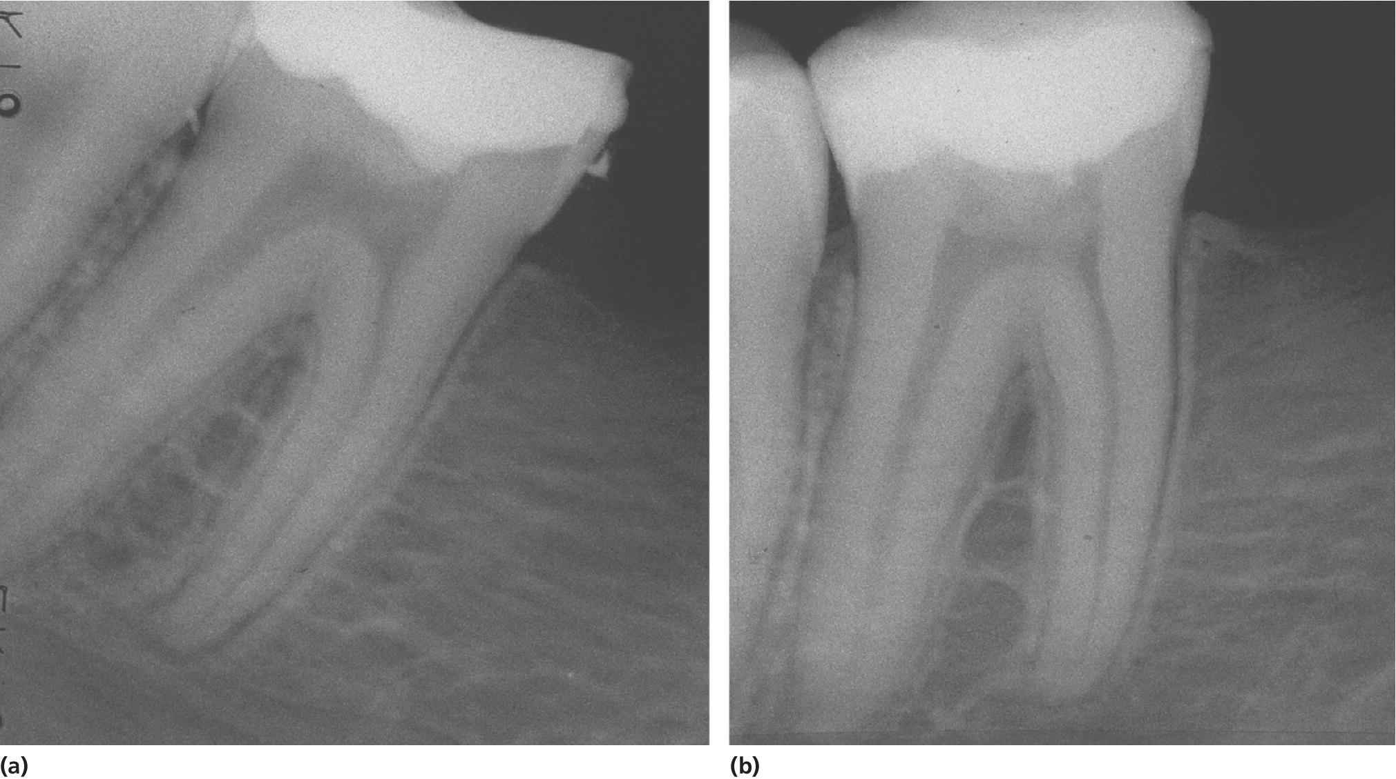 2 Radiographs of partial pulpotomy of permanent molar taken at the time of treatment (a) and 2 years after treatment (b).