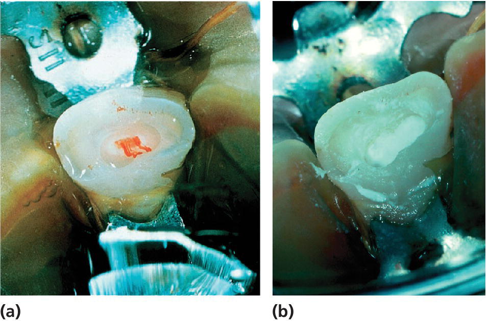 2 Photos of partial pulpotomy of a permanent incisor with complicated crown fracture at the time of treatment (a) and application of calcium hydroxide (b).