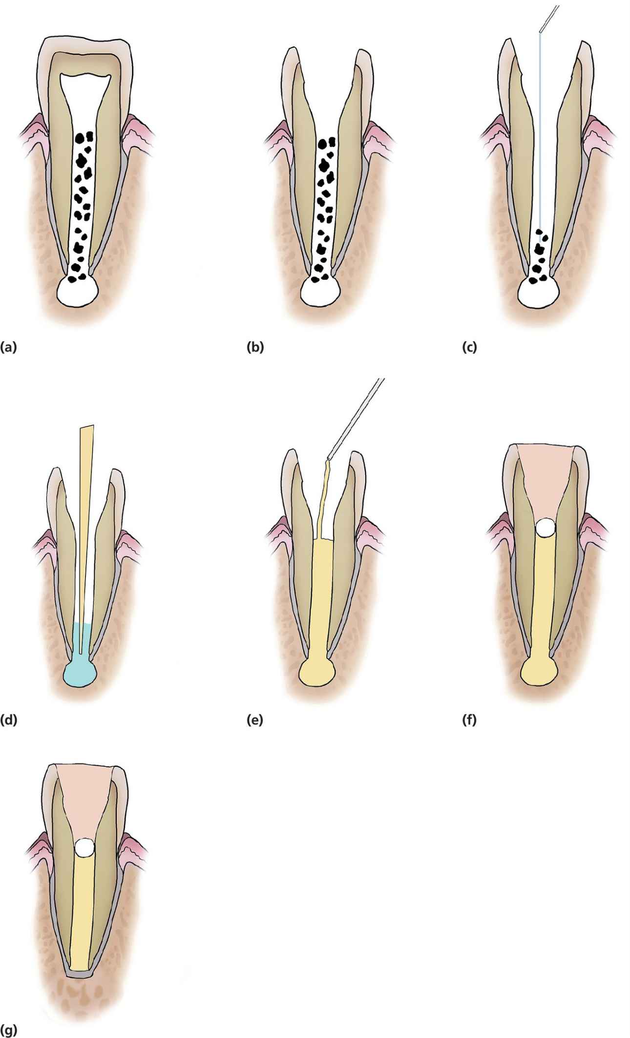 Diagrammatic representation of the stages of calcium hydroxide apexification technique.