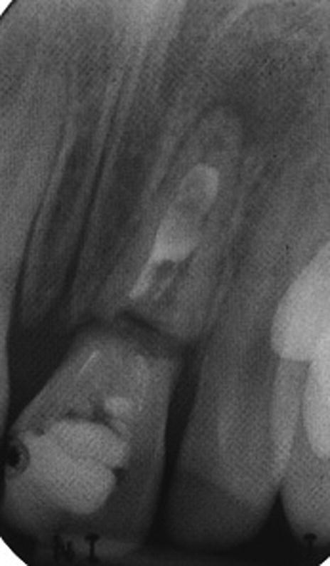 Radiograph of cervical root fracture of a tooth treated with calcium hydroxide apexification.