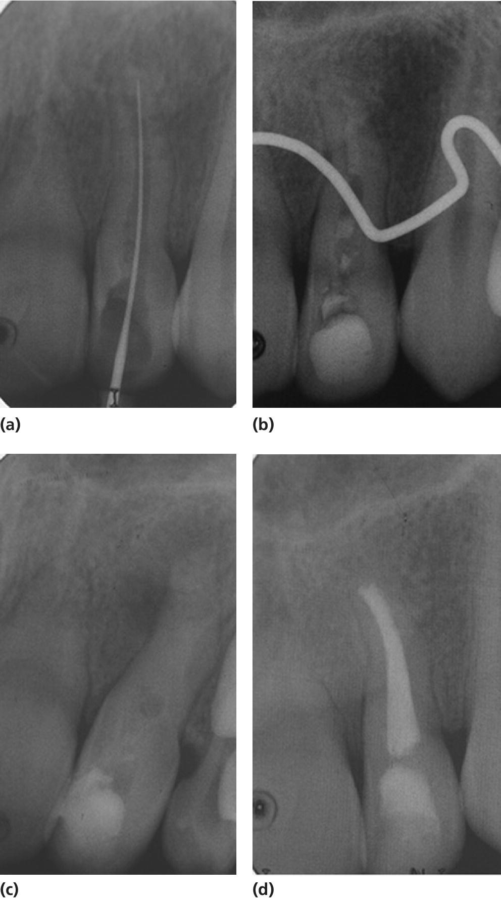 Periapical radiographs of calcium hydroxide apexification of the upper lefet lateral incisor over a period of 9 months.
