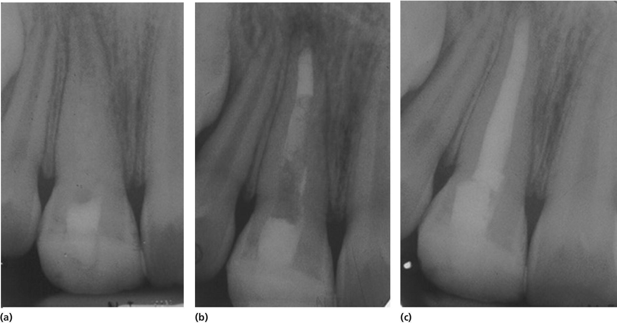 Radiographs of a case treated with MTA plug and Obtura.